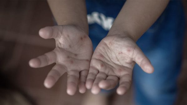 Imigrante registra aumento de casos de mão-pé-boca